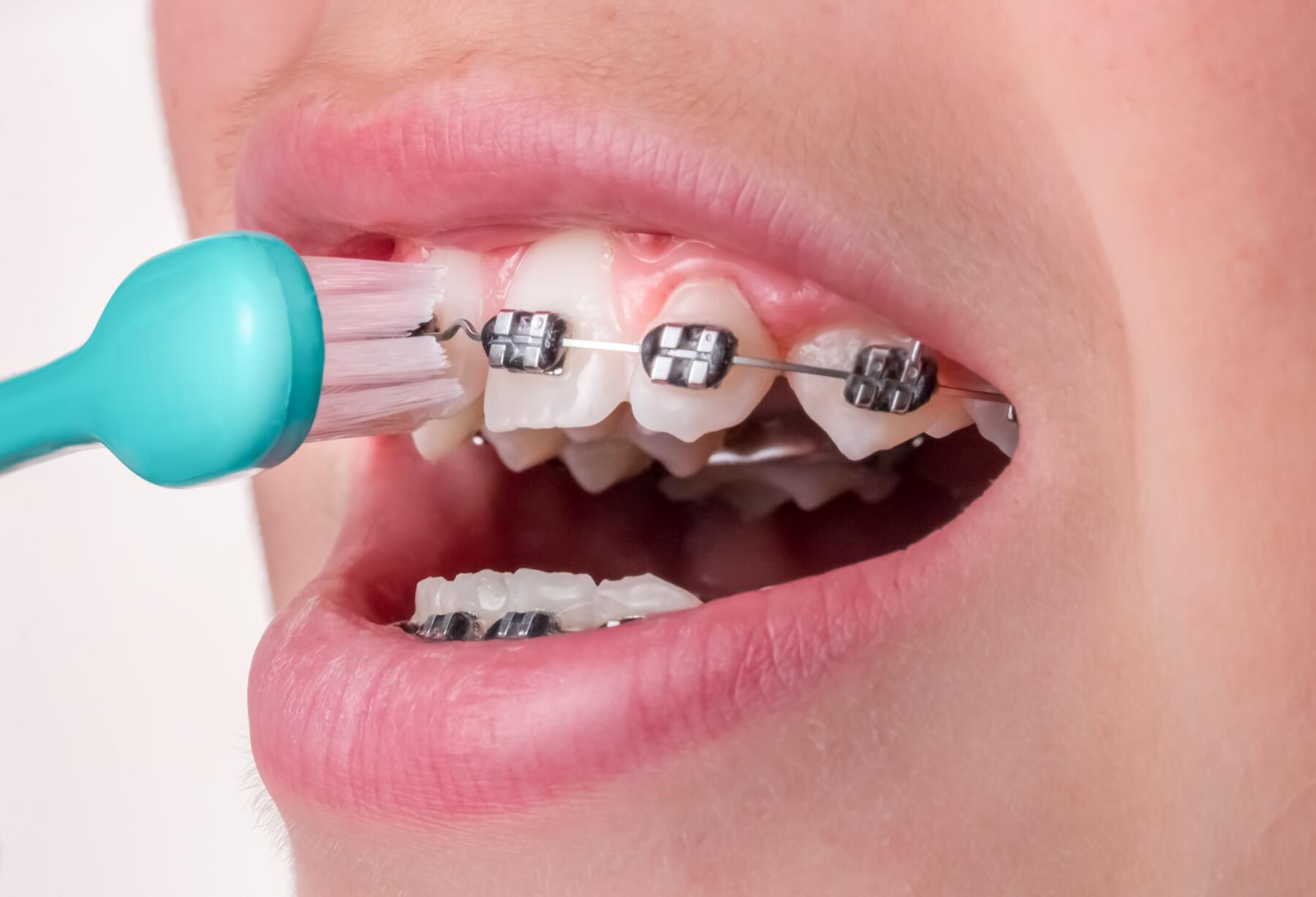 dent mal positionnée orthodontie